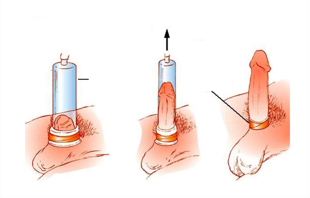 принцип действия вакуумной помпы